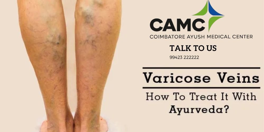 Detangling Varicose Veins Using Ayurveda